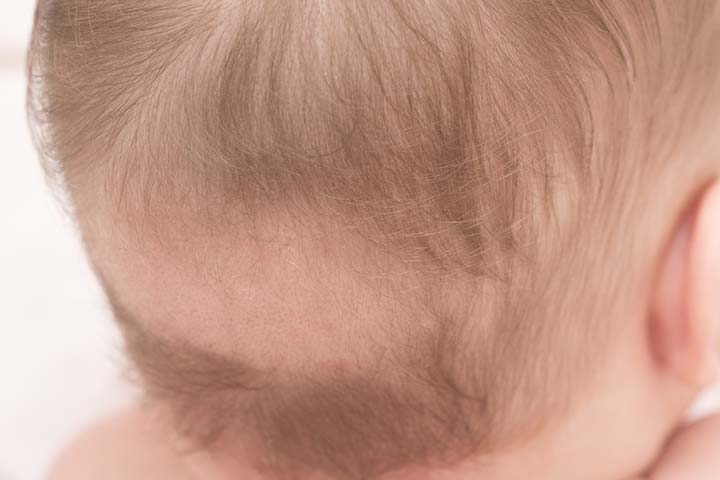 Baby Hair Loss  Reasons  Tips To Prevent