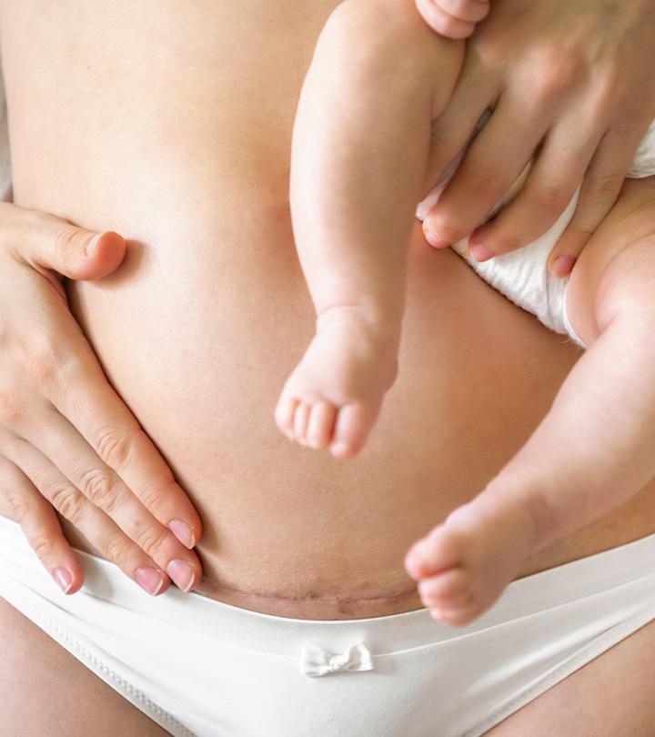 Is It Normal To Experience Swelling Above The Incisions After Having A C- Section