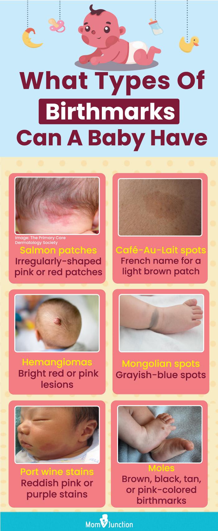 Birthmarks In Babies: Causes, Types And Treatment